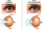 Operativos salud ocular chaco cataratas