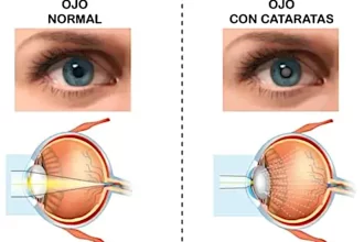 Operativos salud ocular chaco cataratas