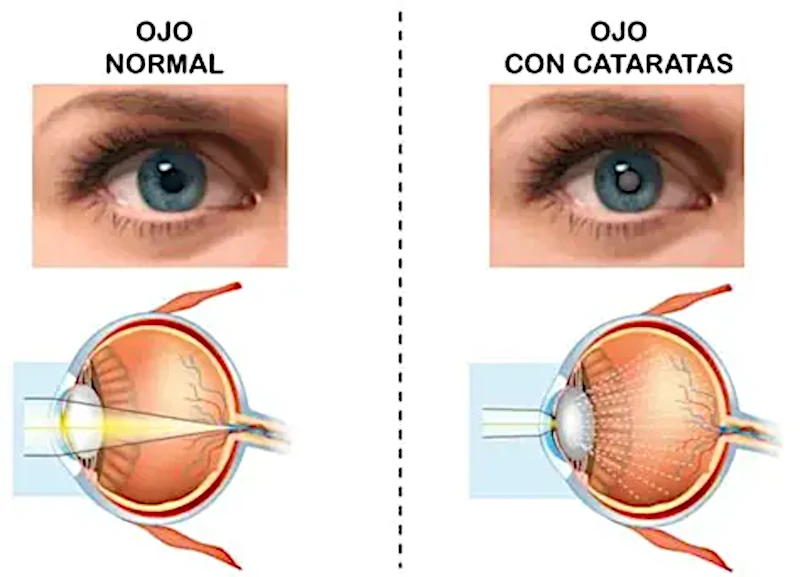 Operativos salud ocular chaco cataratas